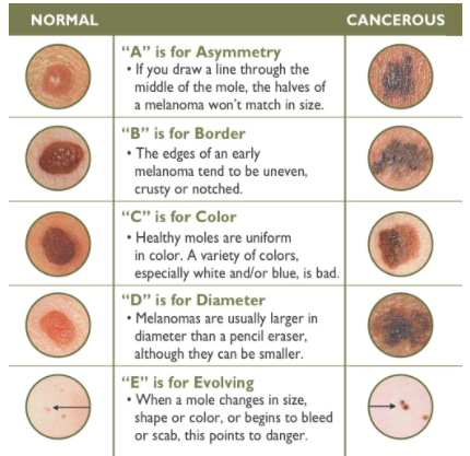 Chart of different skin marks showing normal vs cancerous infographic chart